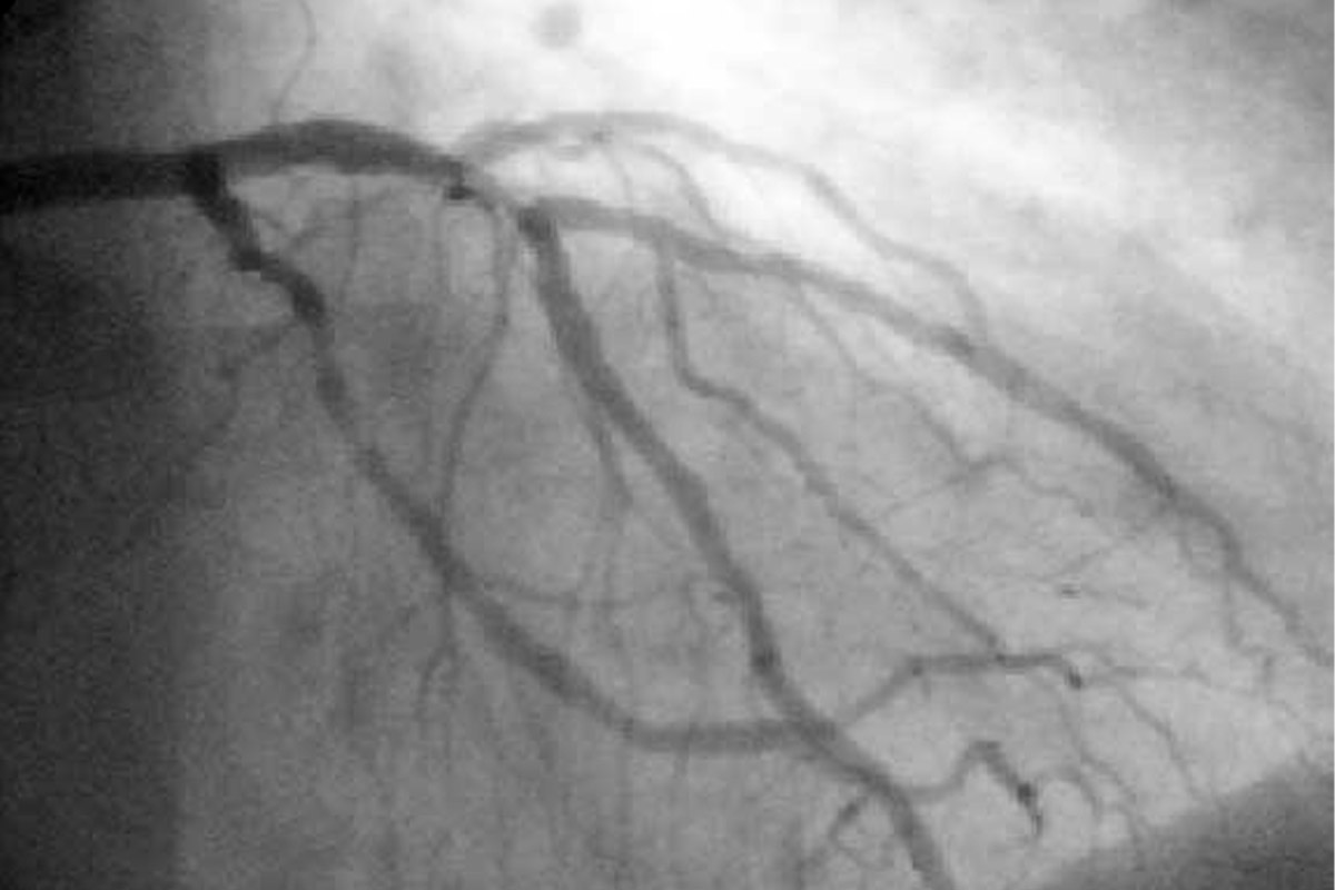 Angiografía coronaria