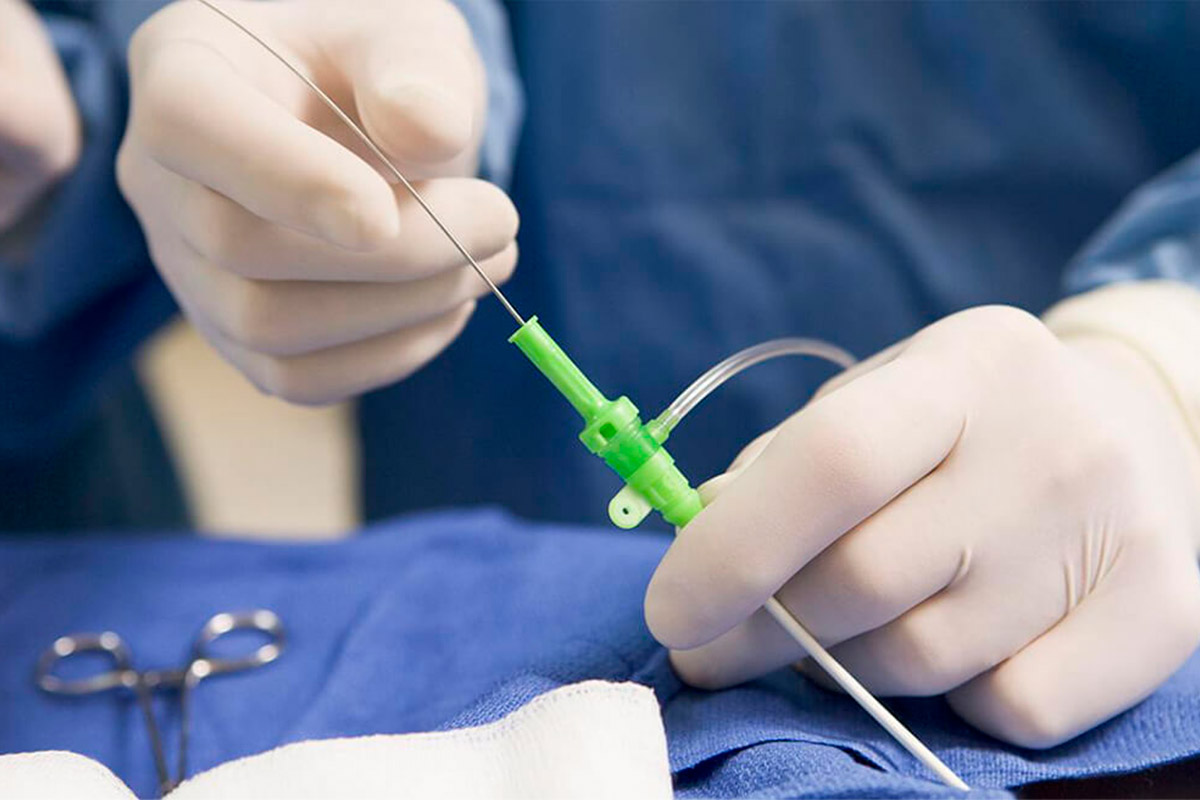 Cateterismo cardiaco.