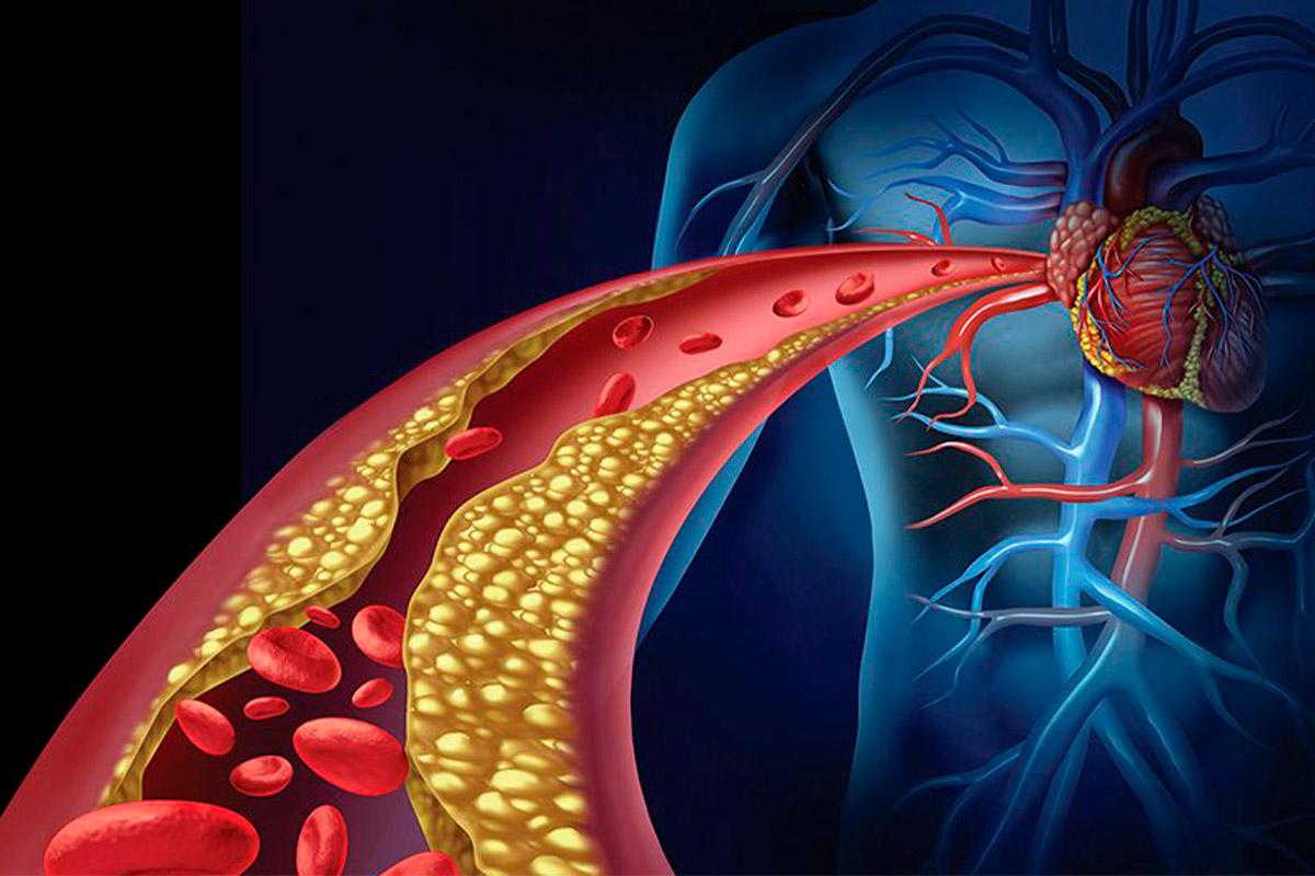 Enfermedad coronaria