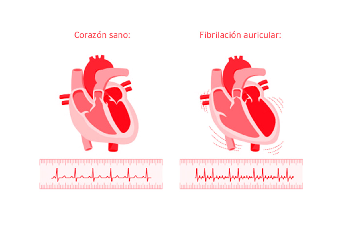 fibrilacion auricular