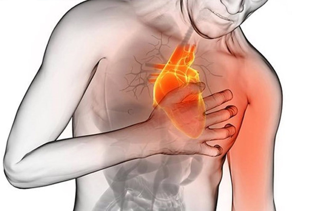 infarto al miocardio