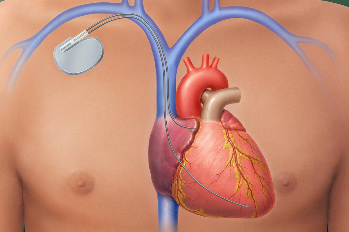 Colocación de marcapasos